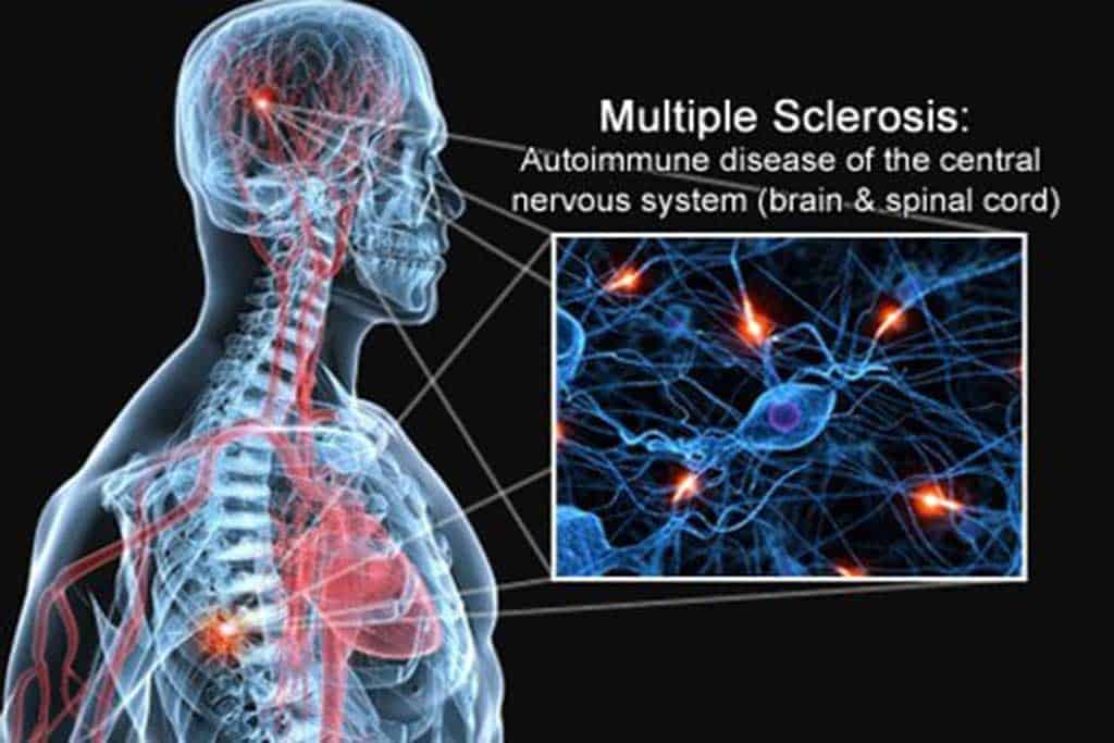 sclerosis